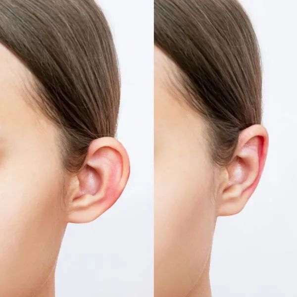 Restore Confidence with Expert Ear Reshaping in Islamabad