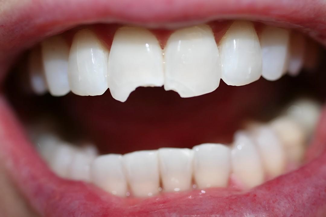 Teeth Fracture Treatment in Islamabad | Expert Relief