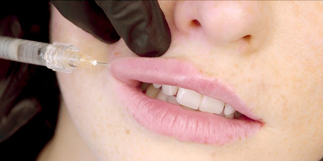 Lip Augmentation in Islamabad: Redefine Your Look